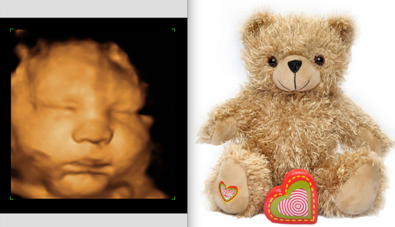 What to Expect in a 3D Sonogram Session